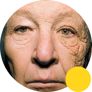 Photoaging sun damage on one side of face