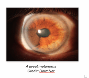 Uveal melanoma