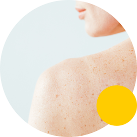 Woman with mole on back